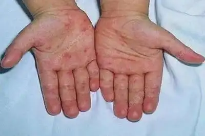 新店镇中心幼儿园《远离手足口病,健康你我他》