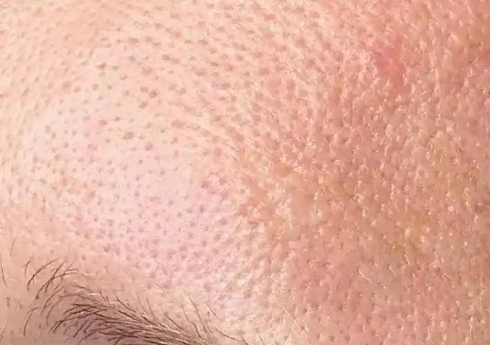 毛孔粗大怎么办不是皮肤疾病却比疾病更恼人