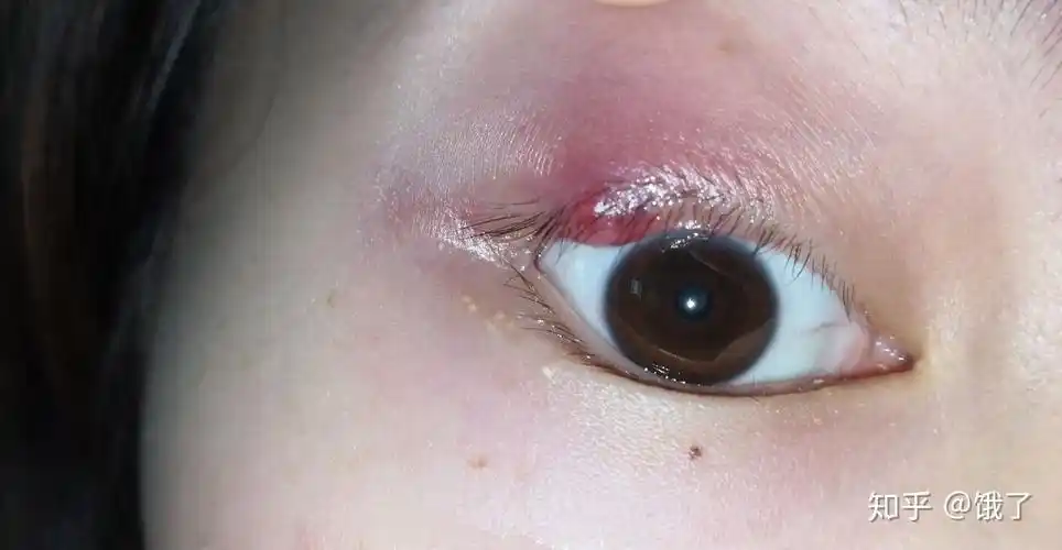 上眼皮麦粒肿了,还挺大,出现了脓头,该怎么办啊?求大神们分享 - 知乎