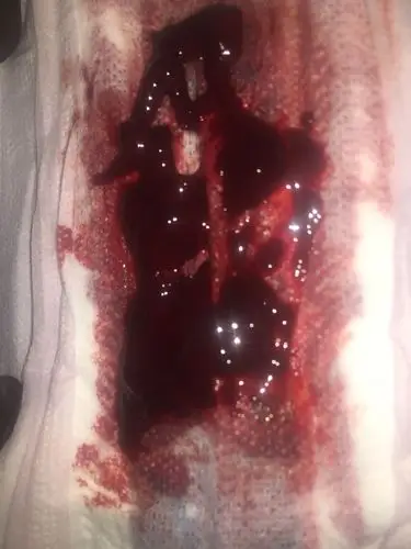 大姨妈十天前来了…现在又来了…流好多血. 还有好多一坨一坨是什么鬼