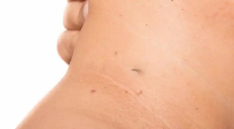 脖子上长的"小肉粒"能揪掉吗?_治疗_激光_皮肤