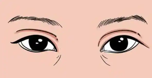 上眼睑提升手术怎么样?提升效果好吗?费用|恢复时间|后遗症