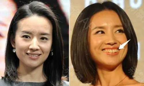 有网友反映,是因为董洁之前做了牙贴片,导致牙表厚厚的一层,不仅嘴包