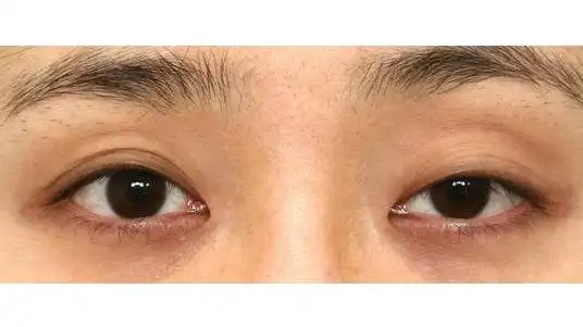 割双眼皮前先看看你是不是"上睑肌无力"