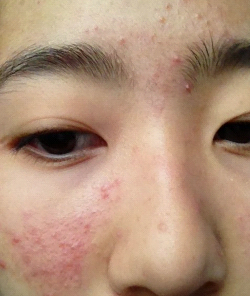 皮囊炎会自己好吗