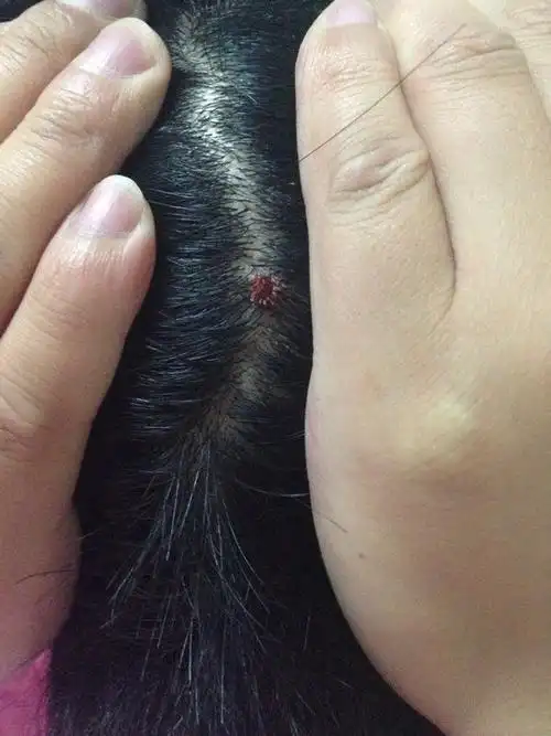 头皮菜花样疙瘩2月余.