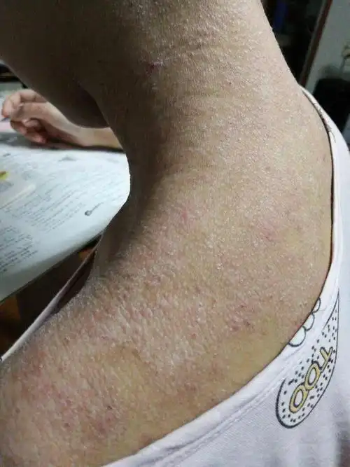 干燥脱皮瘙痒,特应性皮炎,拿什么来拯救你