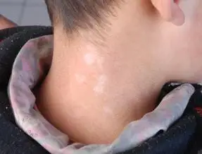 新闻 疾病科普 第四,在春夏季人们穿的衣服比较暴露,而暴露部位的皮肤