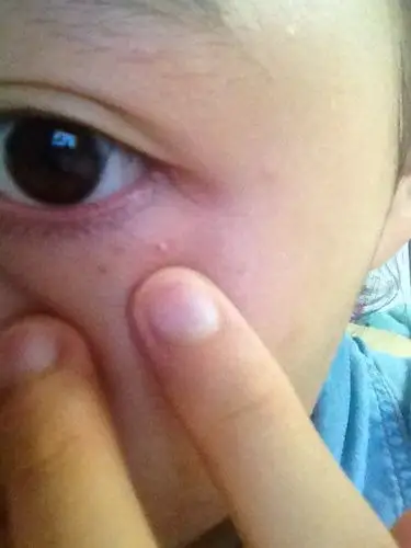 眼角下面的脂肪粒一个多月了已经是白色的了,想用手挤掉结果没挤破