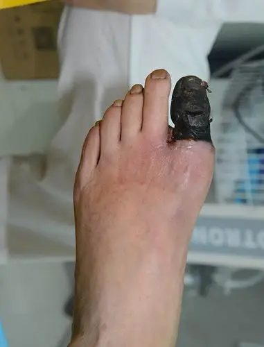糖尿病足大脚趾发黑发干坏死了还有办法治疗吗?