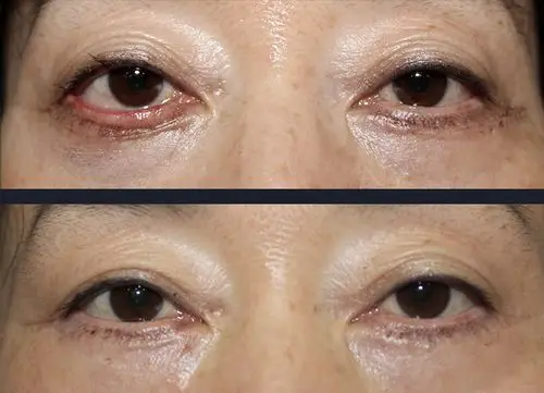 下眼睑退肌指的是下眼睑下沉