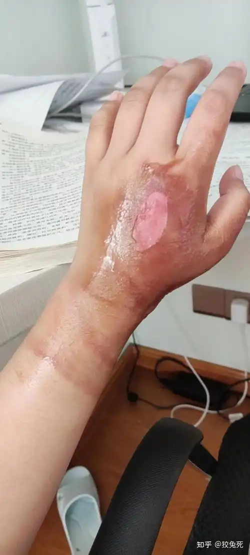 浅二度烫伤愈合过程