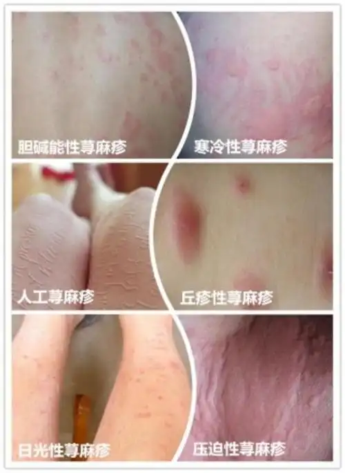 荨麻疹怎样辨别杭州市三院徐瑾医生提醒有这些症状就要注意啦