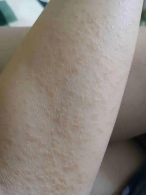 请问这是什么皮肤病 不疼不痒很多年 密密麻麻像痱子