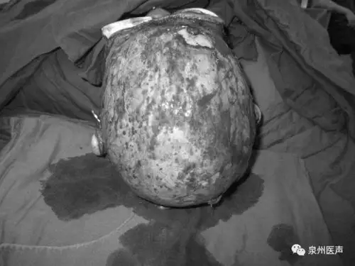 又一例!女子长辫被卷机器致头皮完全撕脱!