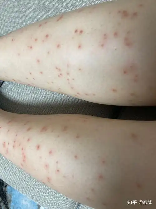 记录腿部脱毛经历冰点脱毛引发毛囊炎持续更新