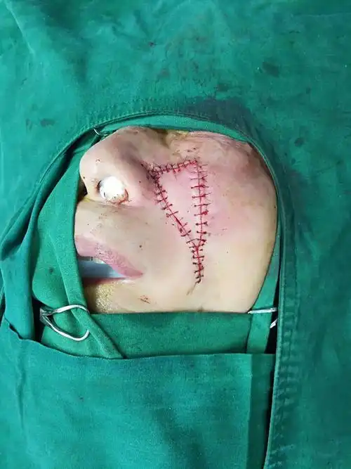 面部肿瘤的整形外科手术治疗