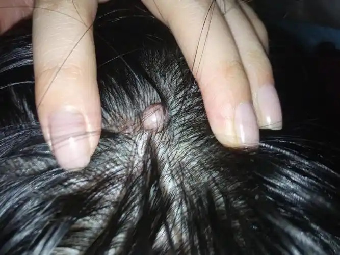 头上有颗超级大的瘊子,大约有小拇指最上面指节那么大.