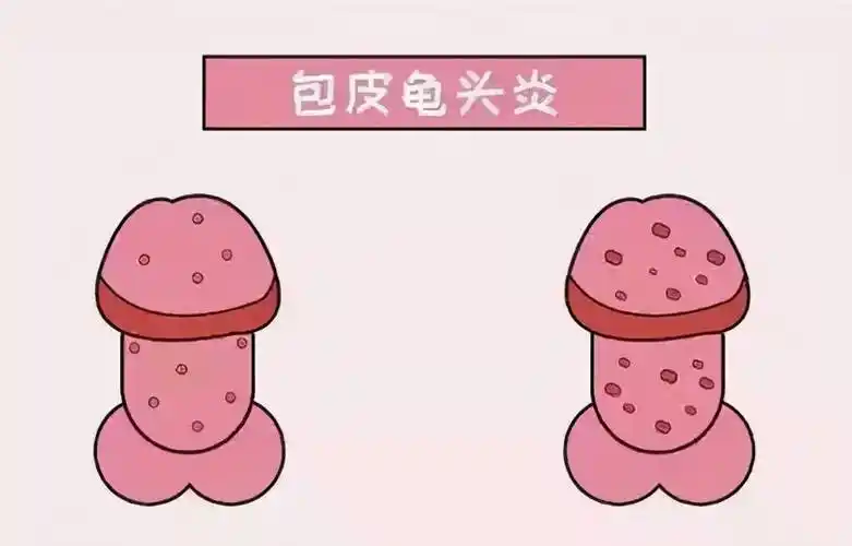 包皮龟头炎具有传染性,会严重影响性生活,甚至传染给伴侣,所以如果患