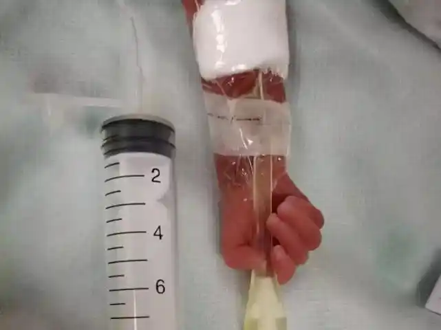 揪心!女子怀孕5个月生下"针筒"宝宝 仅800g重