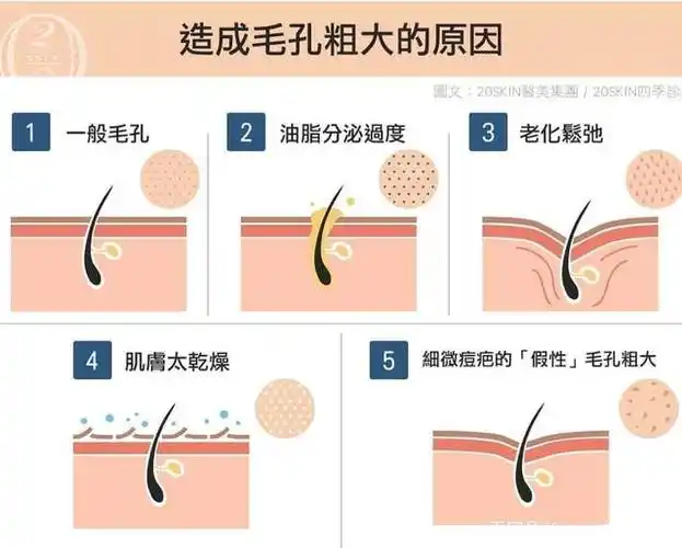 想要解决毛孔粗大问题,你知道自己是属于哪种类型的毛孔粗大吗?