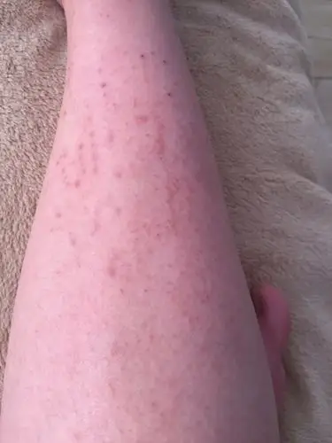 孕妈有没有孕晚期身上特别痒的