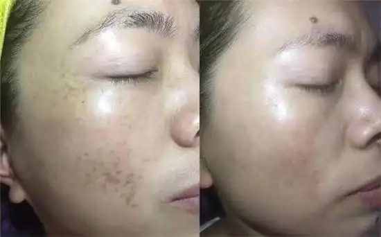 汉苑良方百消丹玉妍丸使用效果怎么样实际体验功效检测助你解决祛斑