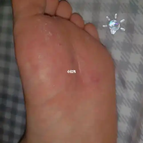 我作为一个女生有脚气是怎样的尴尬