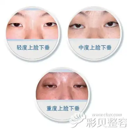 熊医生教你上睑下垂如何辨别