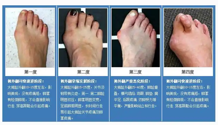 拇外翻需要手术矫正.