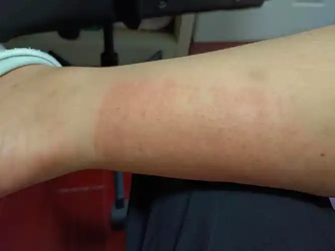 膏药过敏了怎么消啊