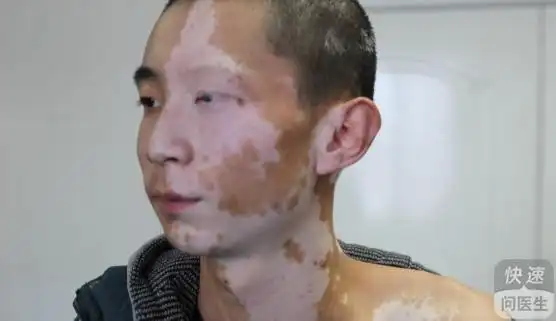 怎么,三大,诱因,白癜风,脸上 核心提示: 面部是白癜风疾病的易发部位