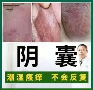 阴囊瘙痒去潮湿肛门私处瘙痒毛壤炎睾丸痒膏冰霜男女私处止痒神器