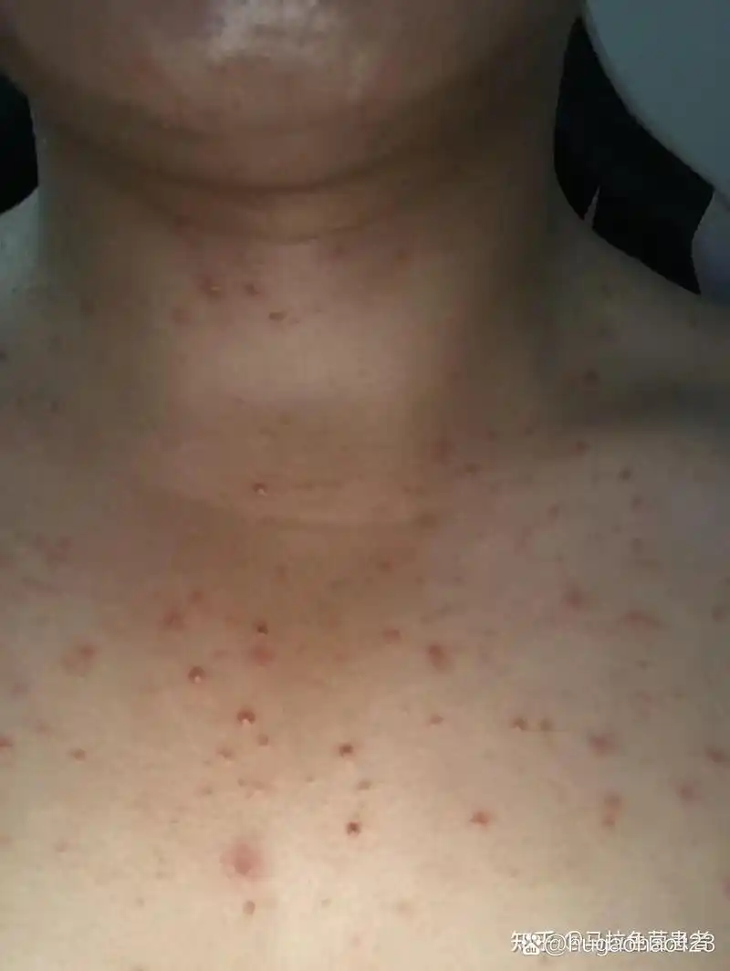 大家帮我看一下我这是毛囊炎吗胸口反反复复一年了一直这样