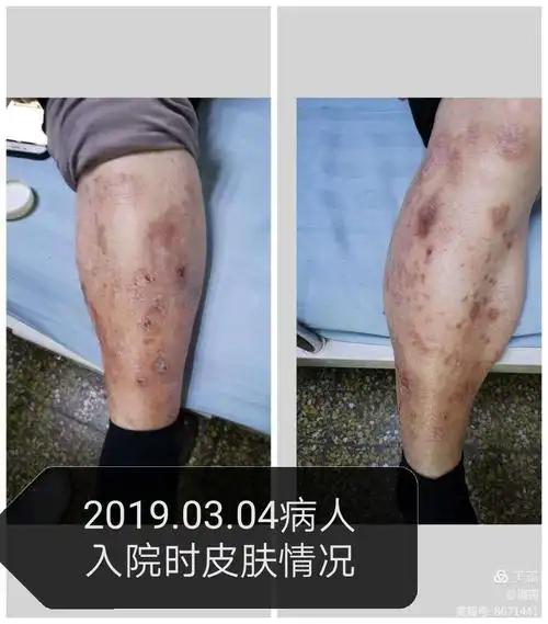 一例糖尿病皮肤病变病例观察
