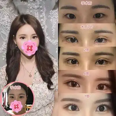 眼综合真实恢复期图片曝光,看完你还敢做吗?