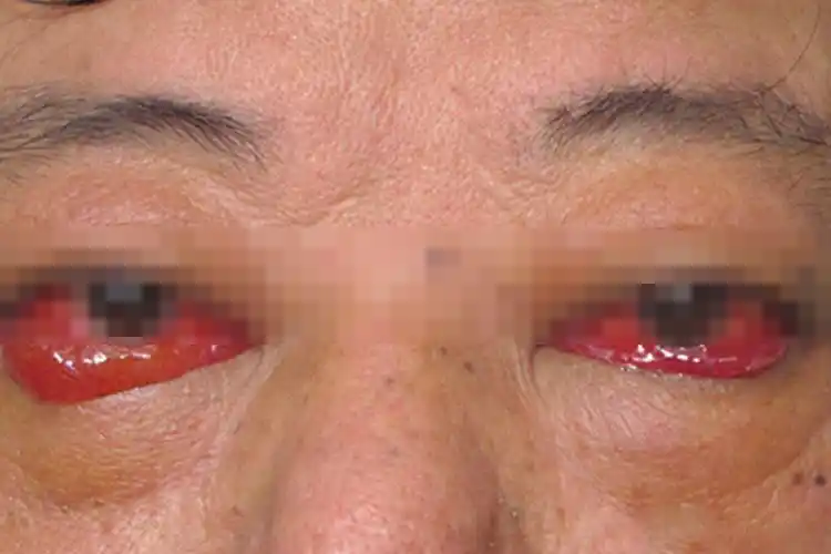 甲亢是什么样的病_有来医生