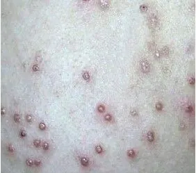 疣治疗,疣症状,疣检查与预防_百姓健康网