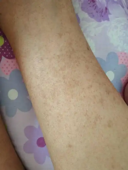 糖尿病腿是这样的怎么回事能不能治疗