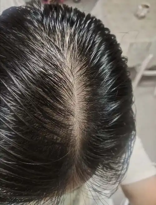 当代秃头少女4个月自救指南过了30岁再护发就来不及了