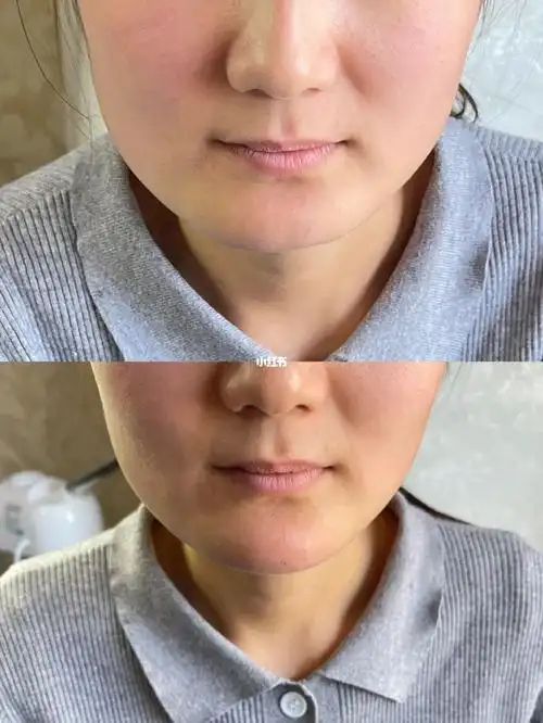 下巴填充即刻效果对比