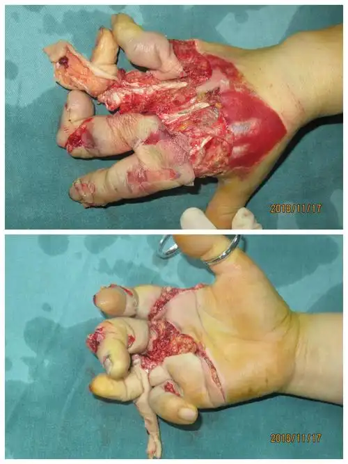 患者,女,右手严重碾压伤.