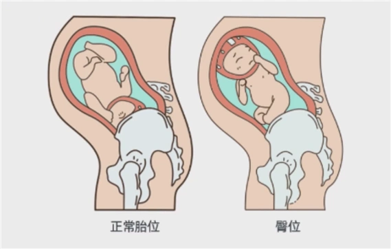 臀位容易导致胎盘早剥,胎膜早破,胎心改变,孕妇可能会面临急诊剖宫产.