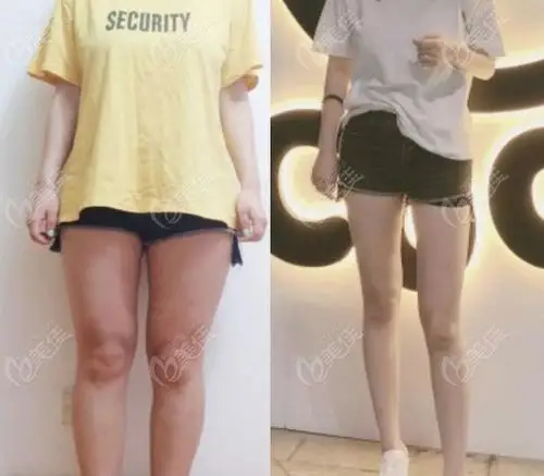 福州格莱美腰腹环吸效果对比图