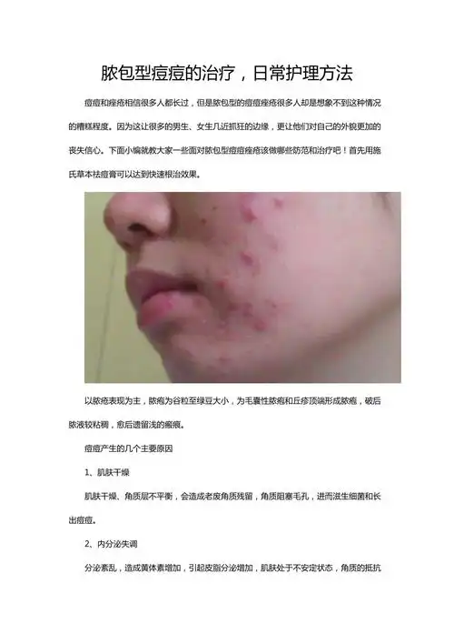 脓包型痘痘的治疗日常护理方法