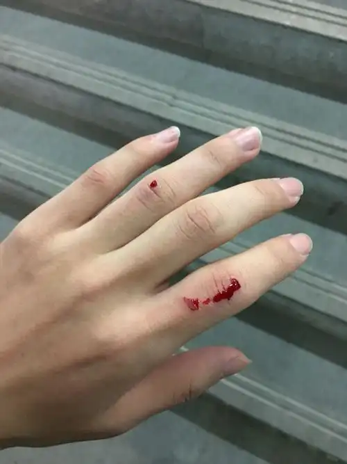 手上刮掉一片肉,容易留疤吗?