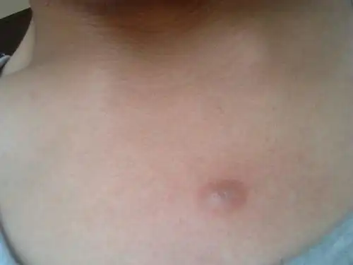 医师来自河北省威县第二人民医院 答: 根据你的图片来看,考虑是毛囊炎