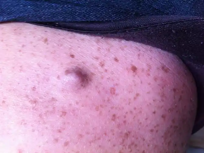 有位亲的身上起了这种疙瘩似的小瘤子,谁能知道这是怎么了,或者这是