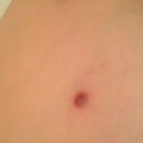 大腿根部长了个红色小肉瘤,想知道是不是网上说的什么疣还是皮脂腺