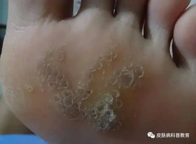 走路硌的脚疼,你的脚底可能长了这些东西._手机搜狐网